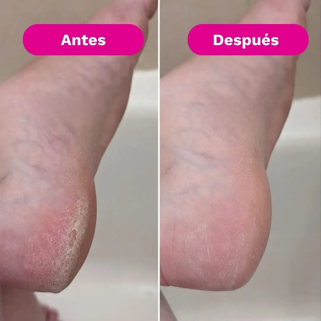 SilkRose™ Pro Removedor de Callos Profesional en Casa
