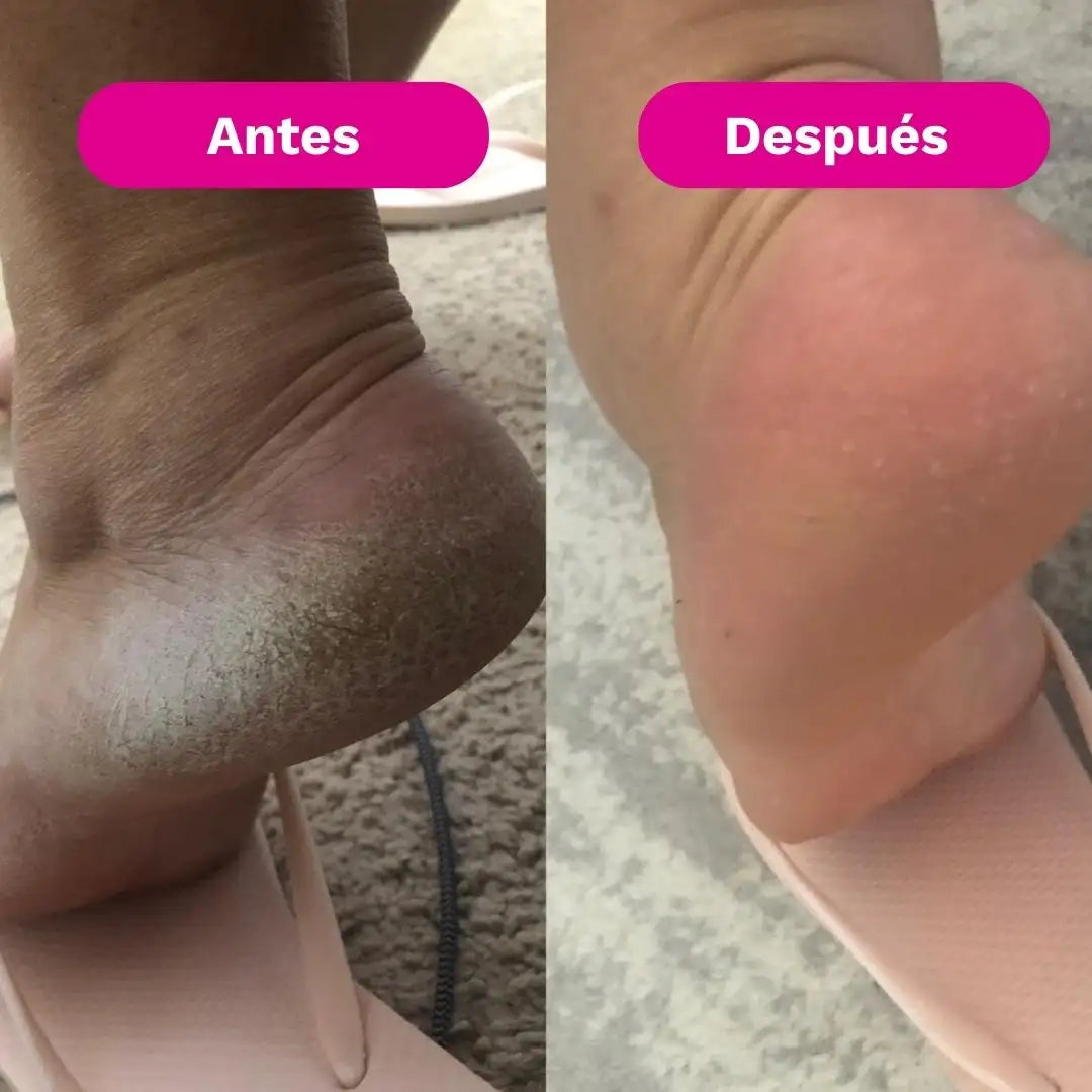 SilkRose™ Pro Removedor de Callos Profesional en Casa